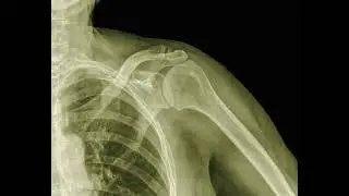AC Joint Arthritis Treatment