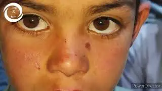 Hirschberg Corneal Reflection Test