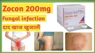 Zocon 200mg tablet use in Hindi / दाद खाज खुजाली की दवा