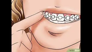 牙套日记2 - 牙套带上不到12天，铁钉就掉了😢 Bracket fell off after 11 days of braces, lol