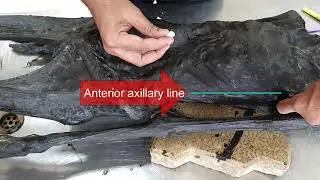 Surface Anatomy of Landmarks of Thorax and Pleura