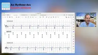 Apprendre à lire un ECG à partir d’un tracé de moniteur cardiaque implantable -Aspects techniques