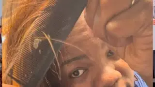 Watch Me Combing My Hair And Lifting Out The Flakes From My Scalp  😳 