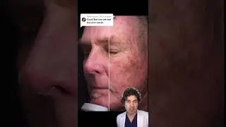 These Anti Aging Laser Treatment Results Will BLOW Your Mind! 🤯 #laserresurfacing #antiaging