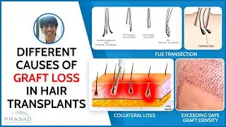 Hair Transplant - Causes of Graft Loss