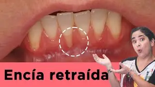 Encía retraida