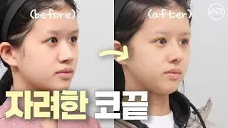 코끝이 전체적인 인상에 영향을 주는 이유 | 후기있음 | 에이비성형외과