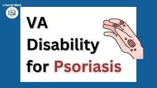 VA Disability for Skin: Psoriasis | #vadisability #psoriasis #vaclaims #veterans #nexus