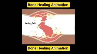 Bone Healing Animation #Tuti hui haddi kaise judti hai? #bone Healing Process#bonefracture Union