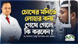 চোখের মনিতে লোহার কনা গেথে গেলে কি করবেন??? ডা.আদনান (চক্ষু বিশেষজ্ঞ এবং সার্জন)