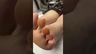 Satisfying Callus Removal by Podiatrist Using Scalpel #ApexFootCare #SatisfyingVideos