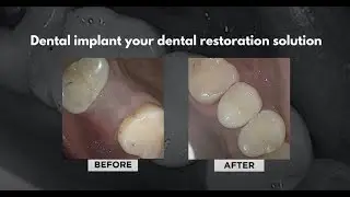 Dental Implant - Solution to Missing Teeth | Angela Leung DDS PC