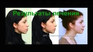 Брекеты - это ровные зубы и красивое лицо