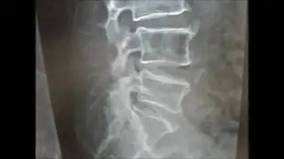 Lumbar Spondylosis And Sacralization At L5.wmv