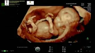 TRISOMY 21 - Down Syndrome - Hydrops Fetalis (Dr Wiku Andonotopo)