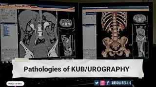 Pathologies of KUB/UROGRAPHY |CT SCAN| By Anis Qureshi