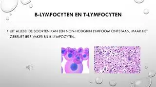 Non hodgkin lymfoom