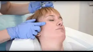 As&iacute; se hace el lifting de 8 puntos con &aacute;cido hialur&oacute;nico. El lifting sin quir&oacute;fano