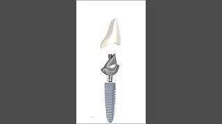Ceramic Crown & Implant Abutment Anatomy