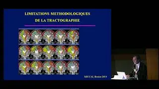La neurochirurgie éveillée