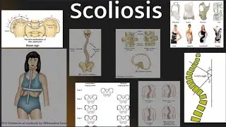 Scoliosis - Definition, Types, Causes, patterns, x-rays, Cobb's angle & physiotherapy management.