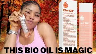 How to use Bio oil to remove your Stretch marks & Acne for face & body, my honest review.