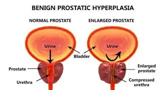 Benign Prostatic Hyperplasia Explained | Pathology 2 | Causes, Symptoms, Diagnosis & Management ---