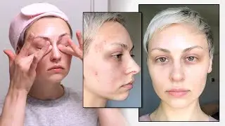 I FINALLY cleared up my skin