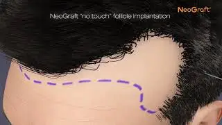 What is Neograft?