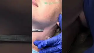 Hydrafacial time with Skinovatio located in Chicago, Illinois