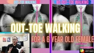 Structural Changes when Out-Toe Walk is Corrected | Manhattan Foot Specialist