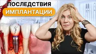 НИКОГДА НЕ СОГЛАШАЙТЕСЬ НА ИМПЛАНТЫ! Последствия о которых молчат врачи!