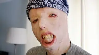 'Joy'- Dave Hammer: Burn Survivor Documentary