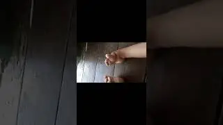 Woman shows off her deformed club feet