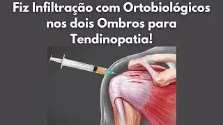 Fiz Infiltra&ccedil;&atilde;o com Ortobiol&oacute;gicos nos dois Ombros para Tendinopatia! #ortobiologicos #cirurgia