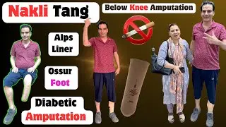 🫵Diabetic Amputation | Artificial Leg Cost | Breeze Foot | Alps Gel Liner | AIIMS | #ossur #3r80