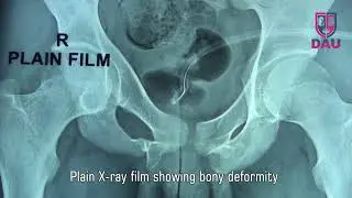 Preputial Tube Urethroplasty for bulbar urethral necrosis  Part 1