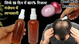 खोये हुए बालों को दोबारा उगायें, गंजापन दूर करें | Lost Hair Growth Challenge | recipe by Dr Upasana