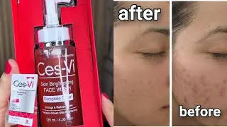 Ces-Vi Face Wash Review | Best Face Wash for Glowing & Clear Skin ✨