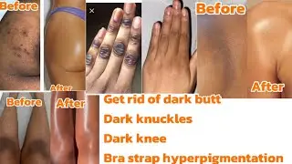 Get rid of Dark Butt, Dark Knuckles etc, in Just 2 weeks | how to get rid of body hyperpigmentation 