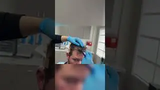Секрет естественной линии роста волос (закрытие височного угла) | Клиника пересадки волос LA FUE