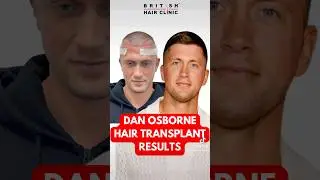 Hair Transplant Results : Dan Osborne #britishhairclinic #hairtransplant