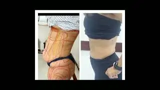 Liposuction 360 by Dr Arif Hussain - Best Plastic Surgeon in Karachi Pakistan