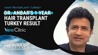 Dr. Anbar's 1 Year Hair Transplant Results at Vera Clinic #hairtransplant #hairtransplantturkey