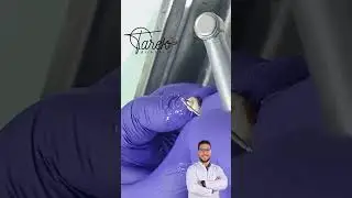 Access opening of lower premolar | Endodontic treatment | Tarek Hussien 