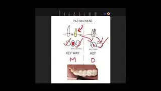 &ldquo;Pier Abutment & Key/Keyway in Dental Bridges | Complete 5-Minute Guide&rdquo;