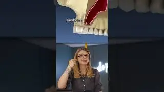 Pose d&rsquo;implants impossible ? D&eacute;couvrez le sinus lift