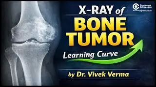 X-ray of Bone Tumors: Understanding the Learning Curve by Dr. Vivek Verma