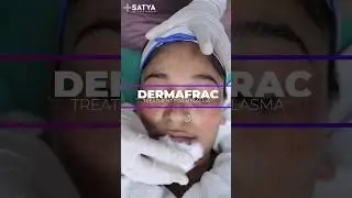 Treat your Pigmentation with DermaFrac Treatment |#pigmentation #dermatologist #skincare #shortvideo