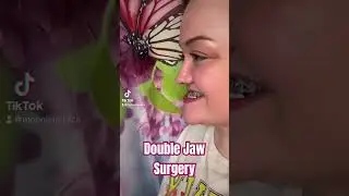 Double jaw surgery and genioplasty! #transformation #beforeandafter #jawsurgery #new #trending